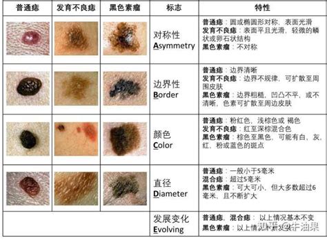 臉頰 痣|痣是什麼？會變成黑色素瘤？7種一定要除的痣